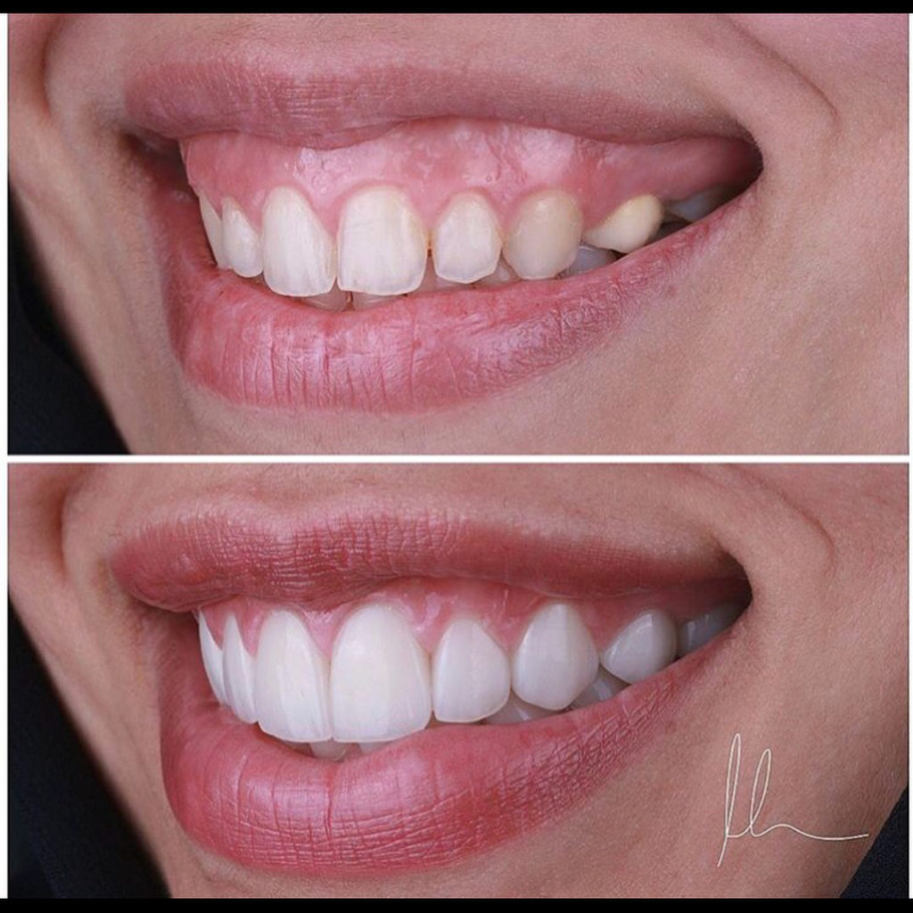 تجميل الاسنان في أبها
