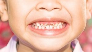 اسنان الأطفال في مدينة المنورة