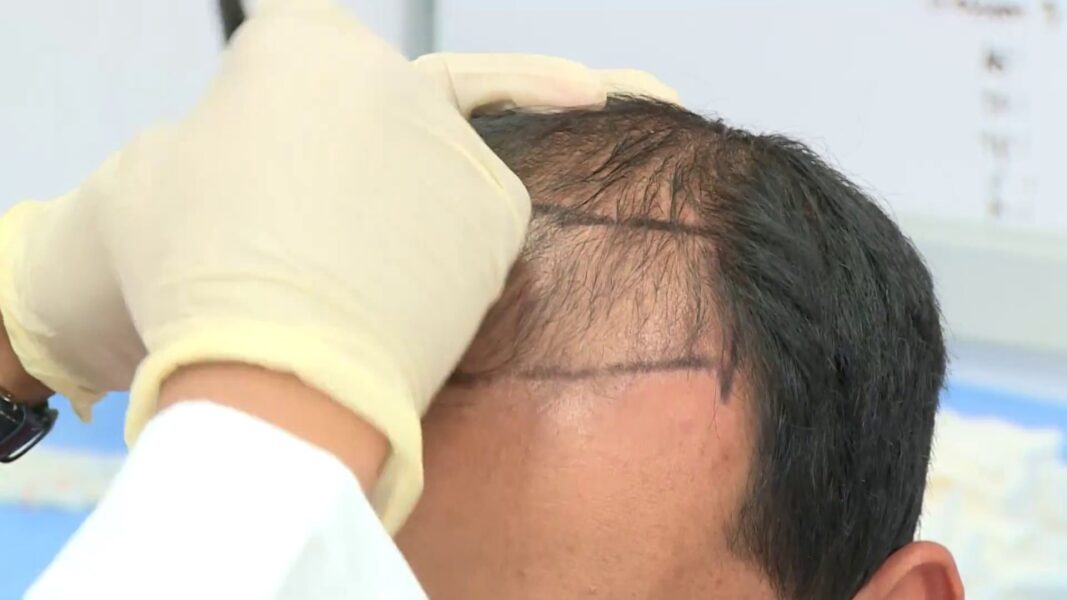 أقوي 4 علاجات في عيادة شعر جدة الفيلر يتصدر موقع أهل السعودية