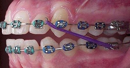 أدوات تنظيف تقويم الاسنان