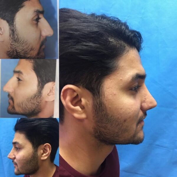 تجميل الانف للرجال قبل وبعد