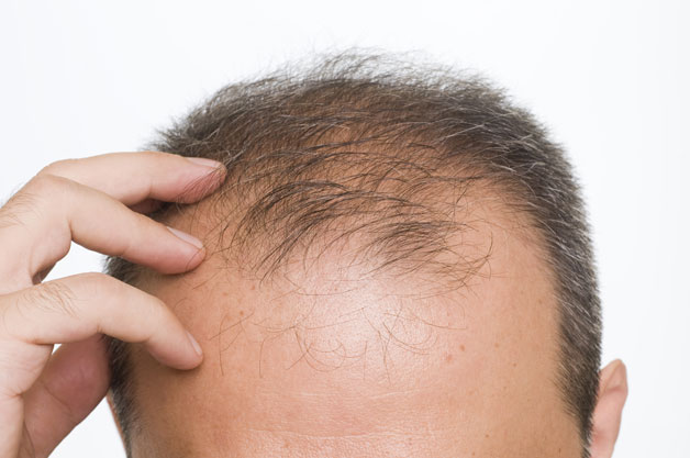 تقصف الشعر عند الرجال