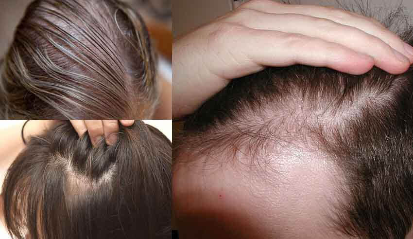 علاج الشعر المتقصف والمتساقط