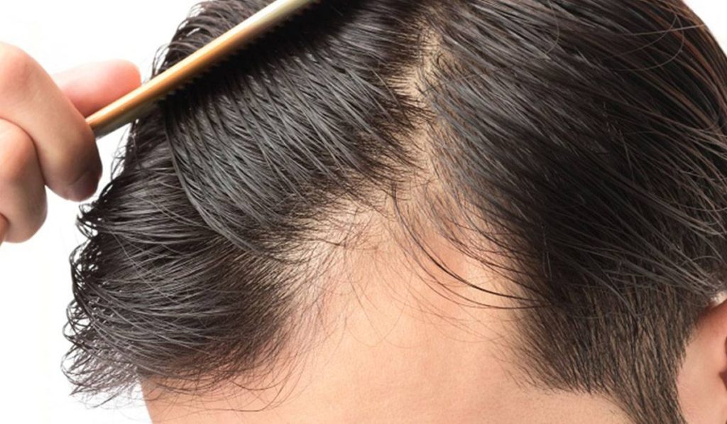 علاج تقصف الشعر للرجال