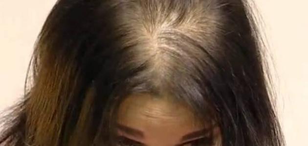 علاج تقصف الشعر من الامام