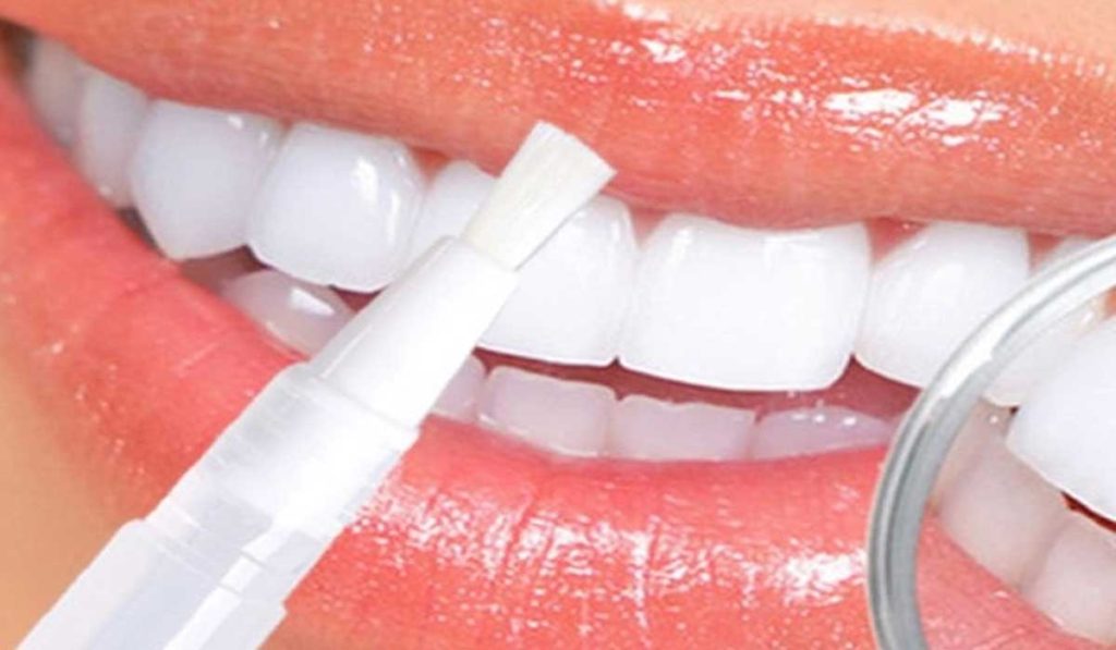 Методы отбеливания зубов. Отбеливание зубов. Отбеливание металлокерамических зубов. Отбеливание зубов улыбка.