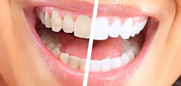 تبييض الاسنان طبيعيا في اسبوع