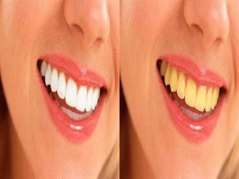 تجارب تبييض الاسنان طبيعيا