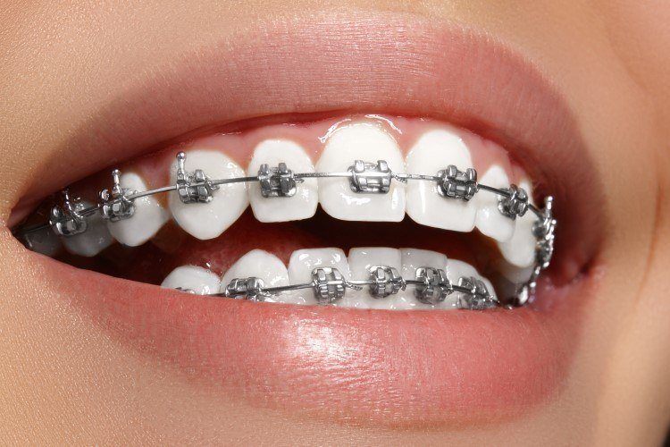 تقويم الاسنان السريع
