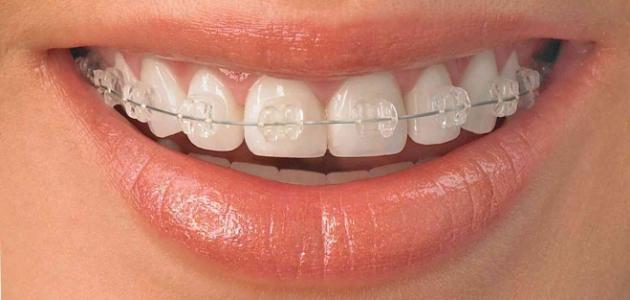 تقويم الاسنان المعدني العادي