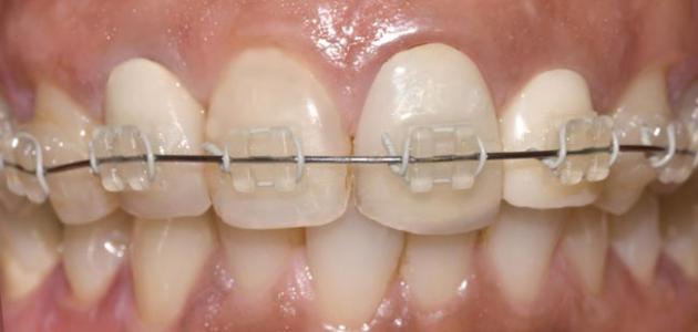 تقويم شفاف للاسنان