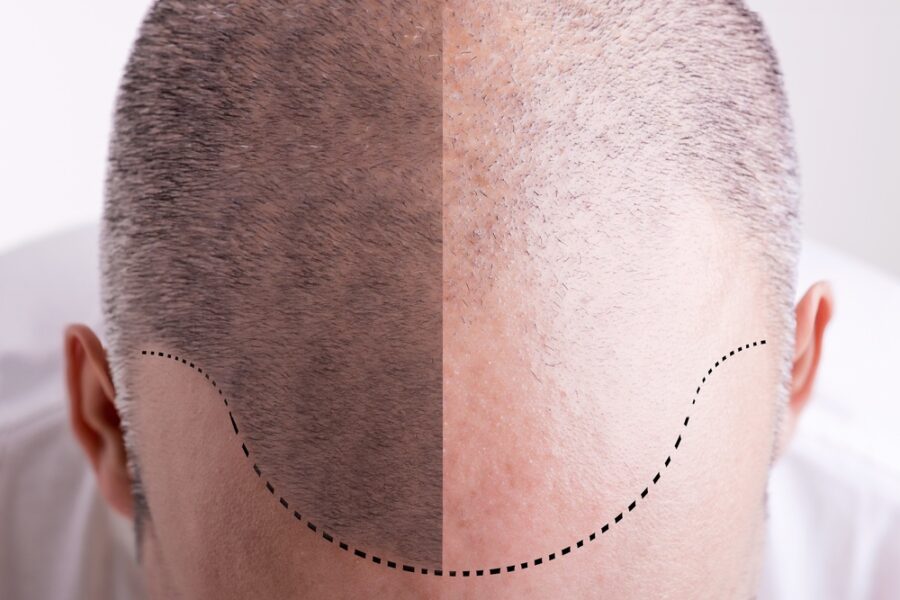 زراعة الشعر