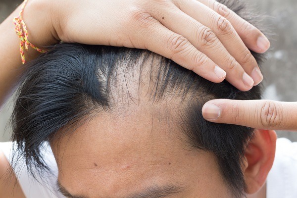 علاج سريع لتساقط الشعر الشديد