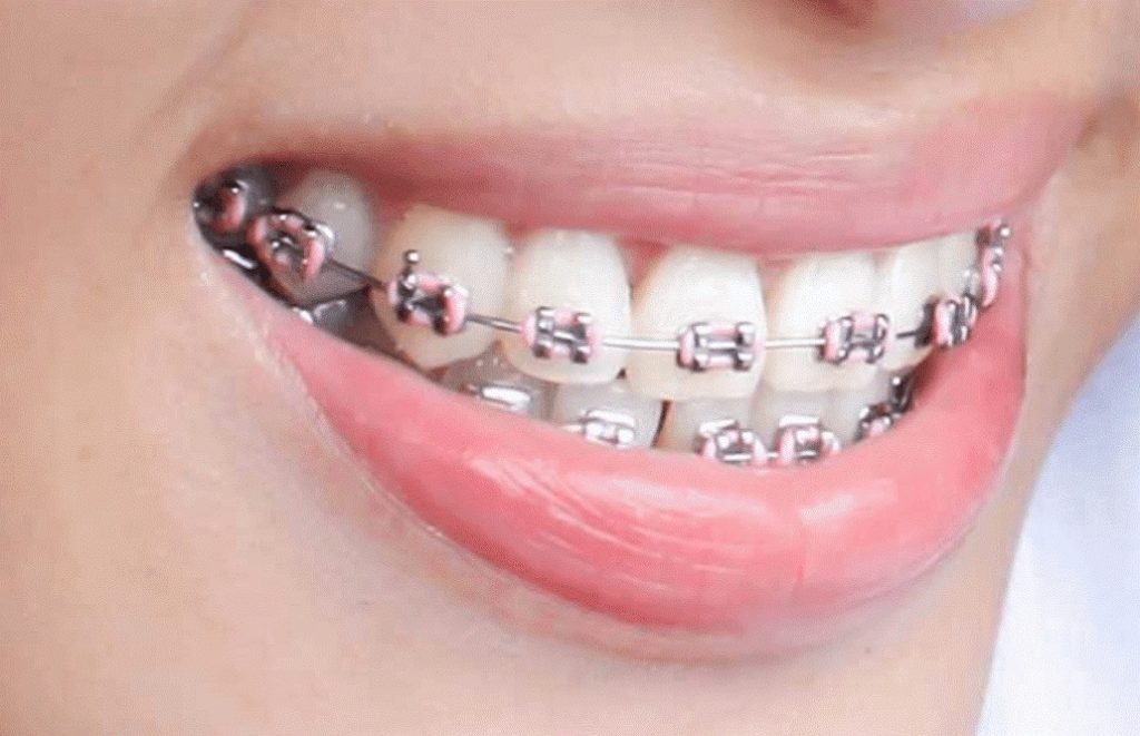 مدة تقويم الاسنان الشفاف