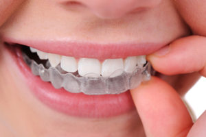 تقويم الاسنان الشفاف في تركيا