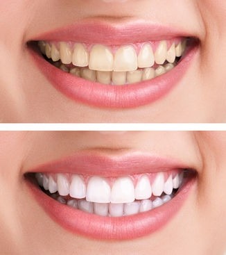 افضل عيادة تجميل اسنان في تركيا