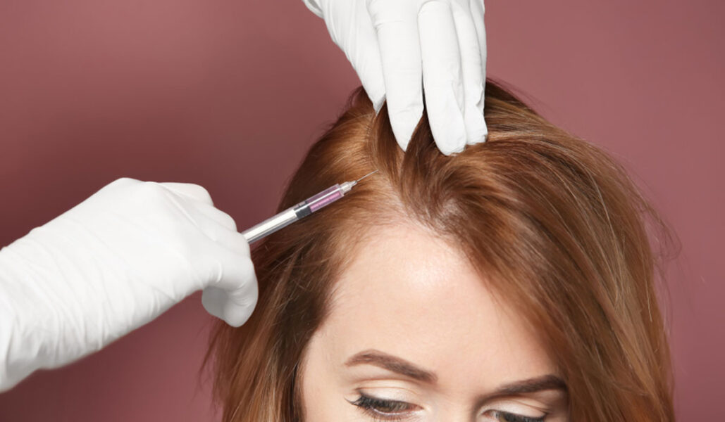 فوائد حقن البلازما بعد زراعة الشعر