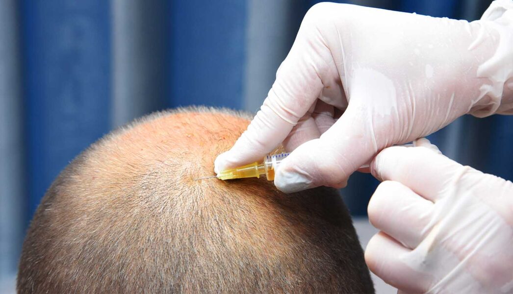 كم مرة تحقن البلازما بعد زراعة الشعر